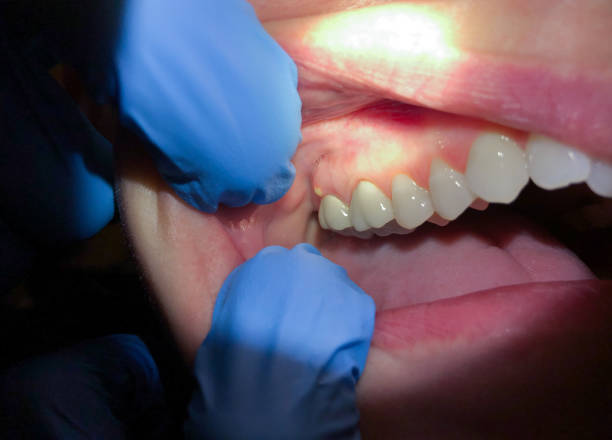 Best Emergency Care for Gum Disease in Waupun, WI
